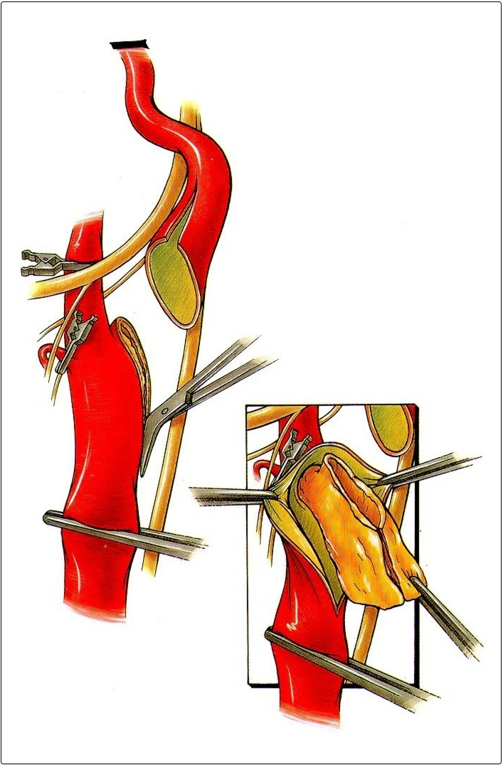Poprečna transekcija unutrašnje karotidne arterije u nivou karotidne bifurkacije