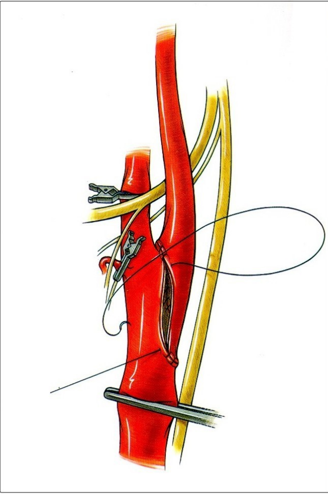 Završavanje everzione karotidne endarterektomije