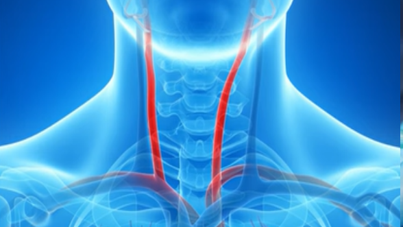Koji su simptomi karotidne bolesti?